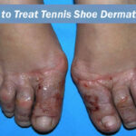 How to treat tennis shoe dermatitis?