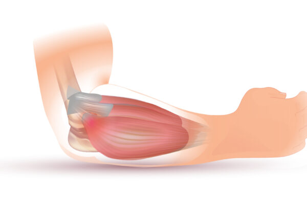 Difference Between Golfers Elbow And Tennis Elbow